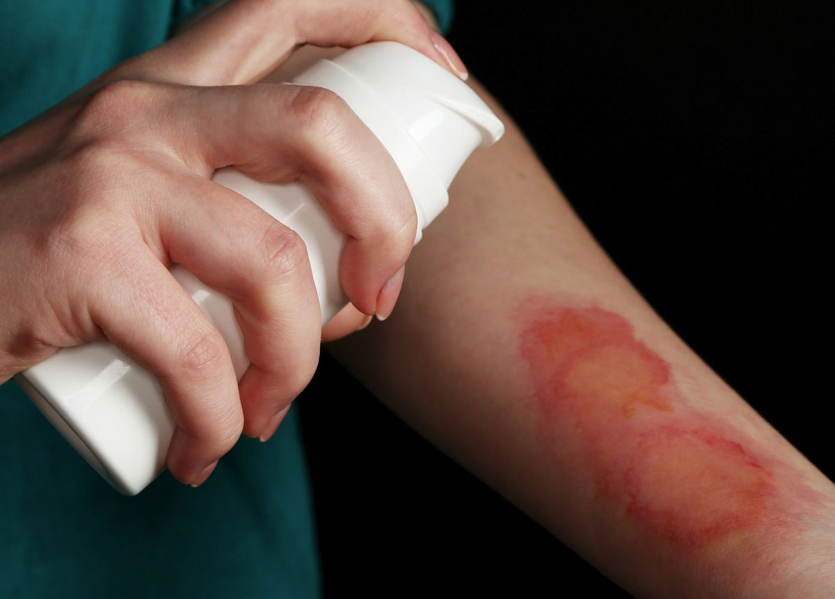 Burn Injuries